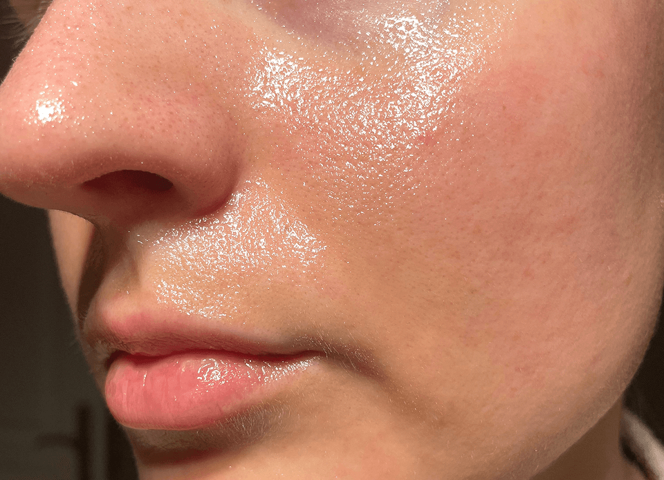 Shiny, enlarged pores and acne-prone.